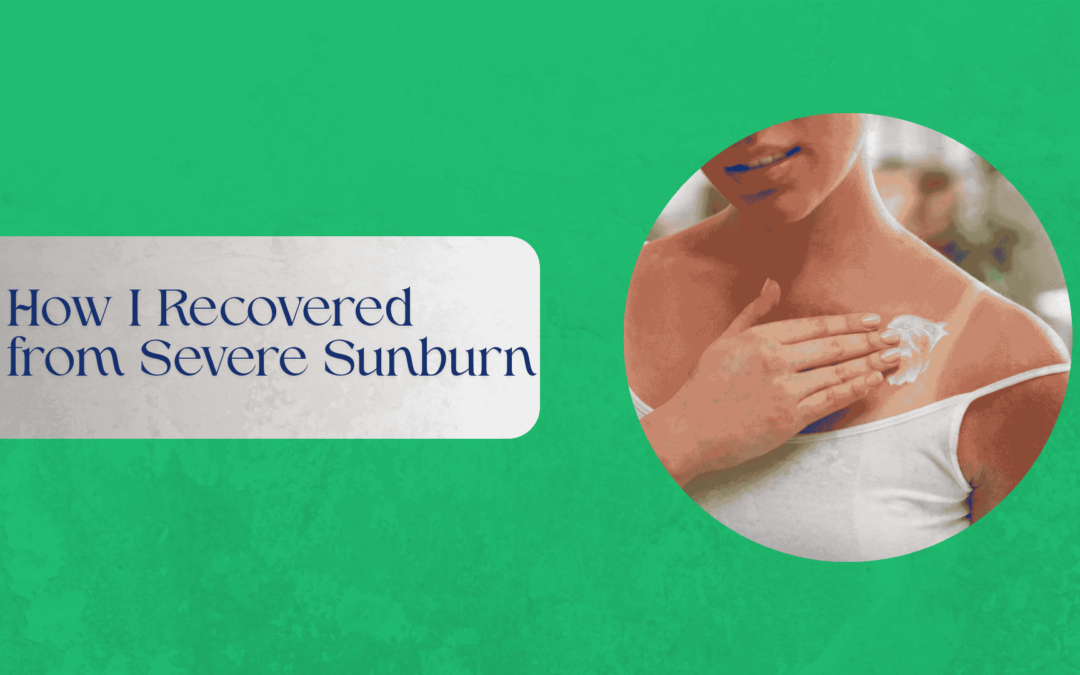 How I Recovered from Severe Sunburn
